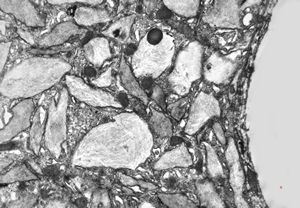 Whipple disease Whipple disease